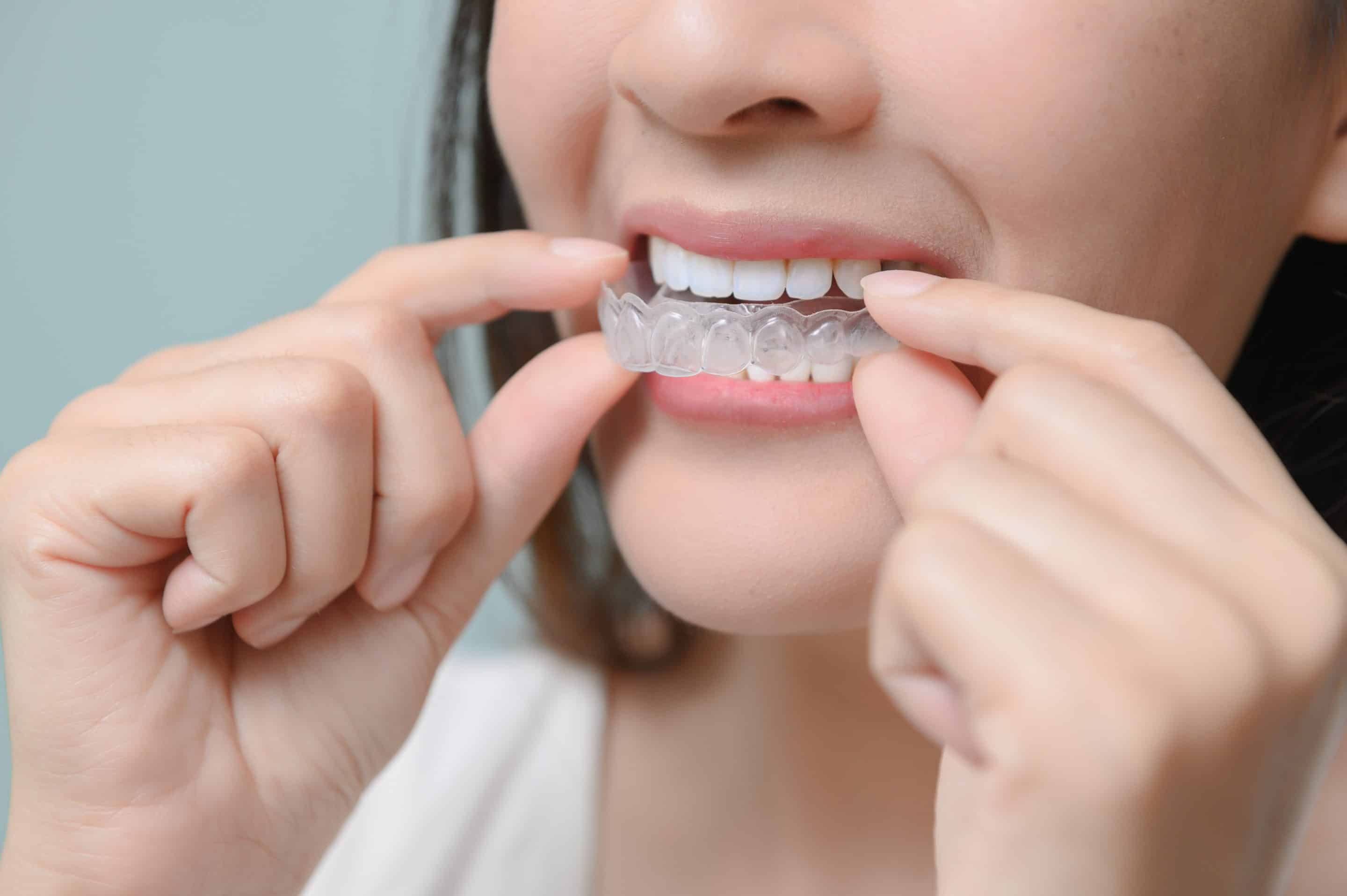 Invisalign Clear Aligners in Charlotte, NC